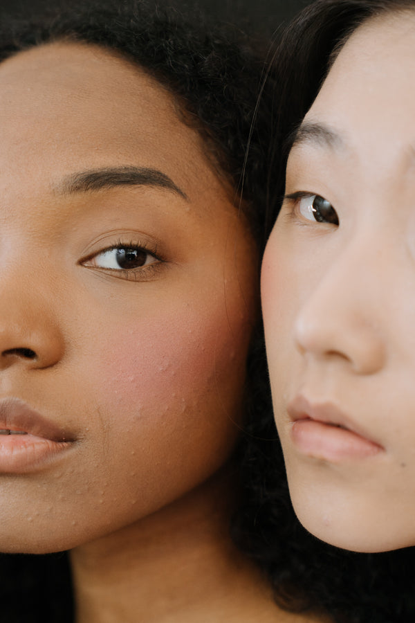 3 ACNE SKIN CARE TIPS FOR A HEALTHIER SKIN